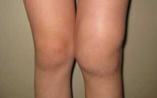 Артроз коленного сустава 4 степени: операция и восстановление