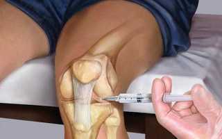 Уколы от артрита: эффективные препараты для лечения воспалений суставов