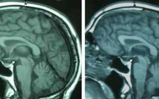 Органическое поражение головного мозга — виды, причины и последствия болезни