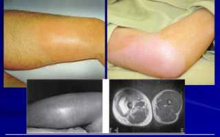 Лечение остеомелита колена остеоперфорацией коленных суставов