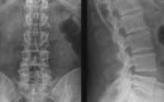 Рентген пояснично-крестцового отдела позвоночника: что показывает