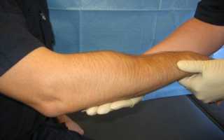 Перелом кисти: симптомы травмы руки, виды лечения