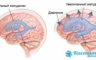 Особенности проявления наружной заместительной гидроцефалии головного мозга