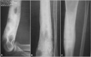 Диагностика остеомиелита — рентгенологические признаки